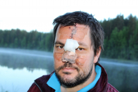 OPERERT: I juni ble Kenneth Balto Pettersen operert for basalcellekreft for andre gang. Fortsatt har han én operasjon igjen.